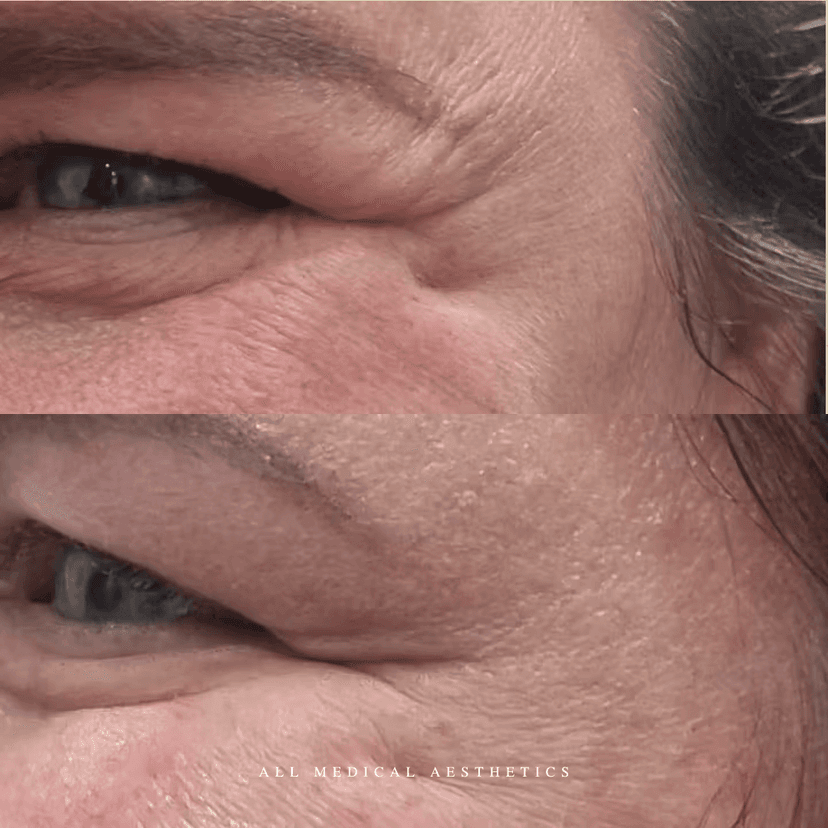 Before and after treatment for lines and wrinkles