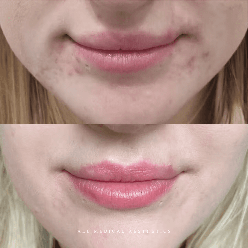 Before and after treatment for dermal filler dissolving