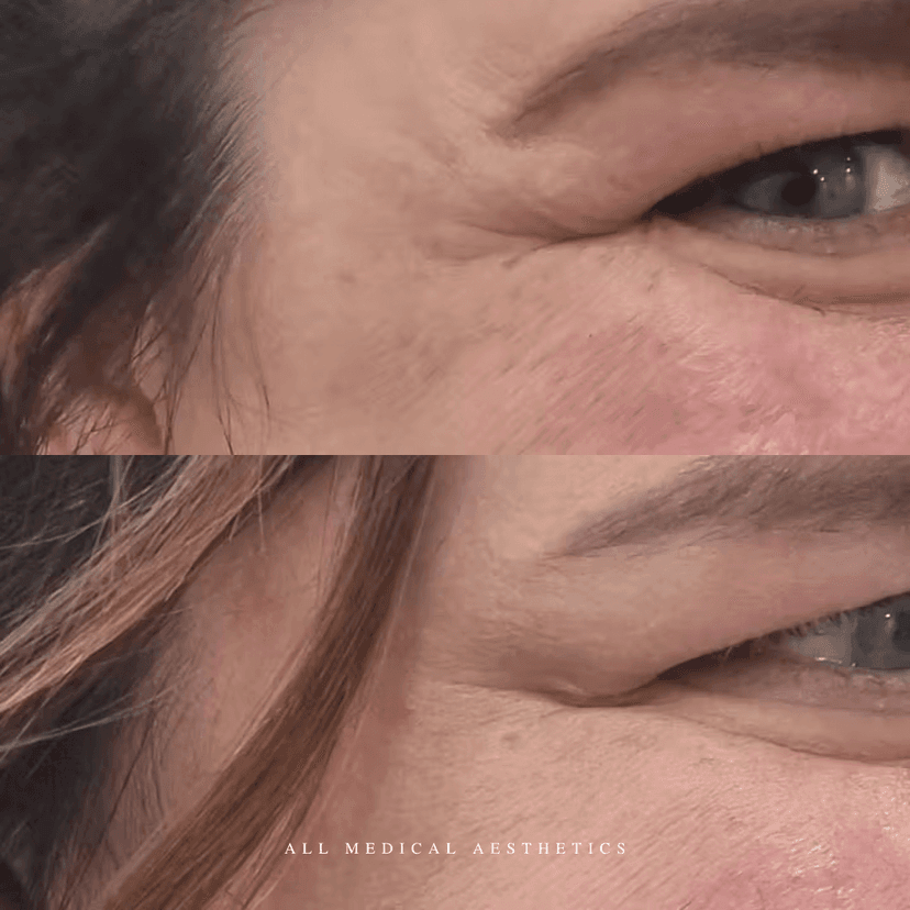 Before and after treatment for lines and wrinkles