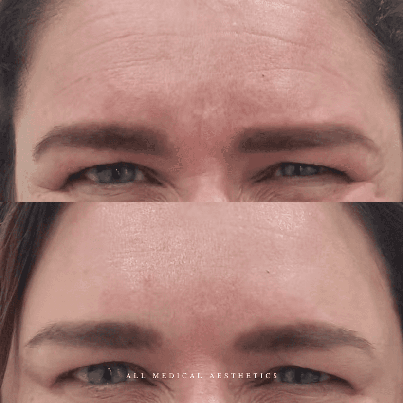 Before and after treatment for lines and wrinkles