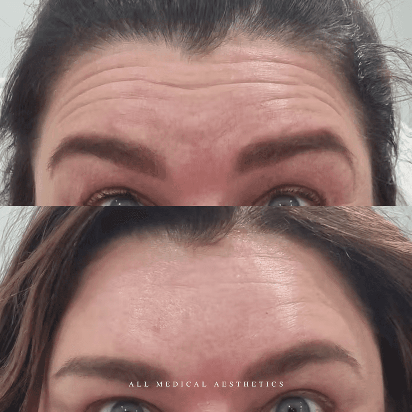 Before and after treatment for lines and wrinkles