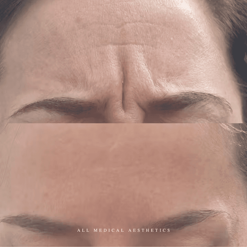 Before and after treatment for lines and wrinkles