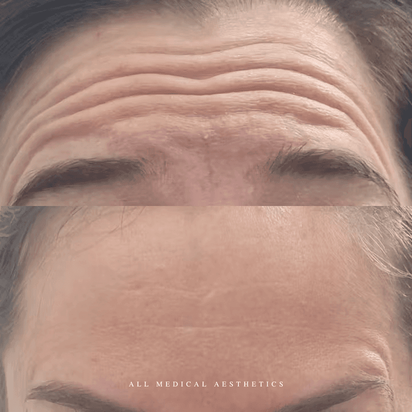 Before and after treatment for lines and wrinkles