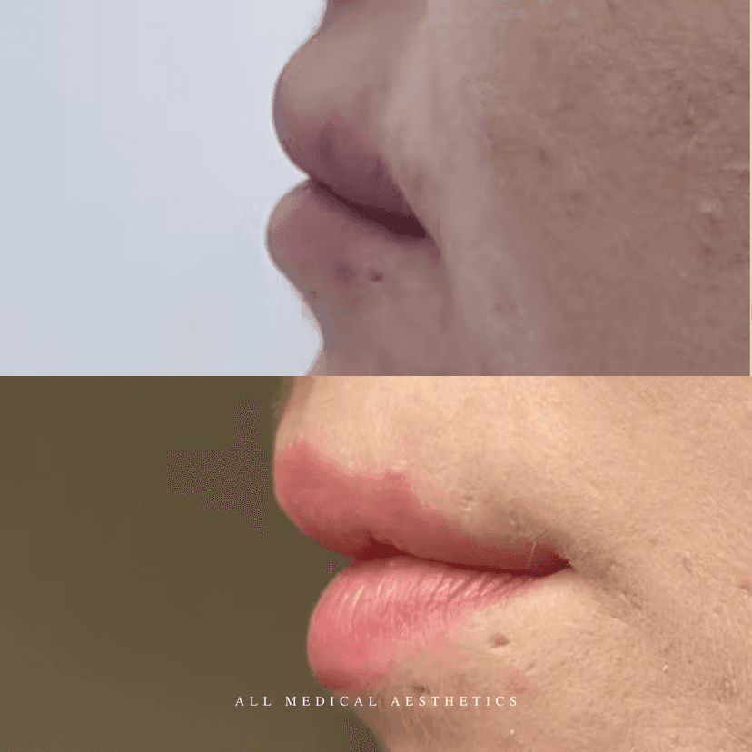 Before and after of filler dissolving