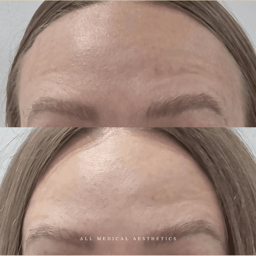 Before and after treatment for lines and wrinkles