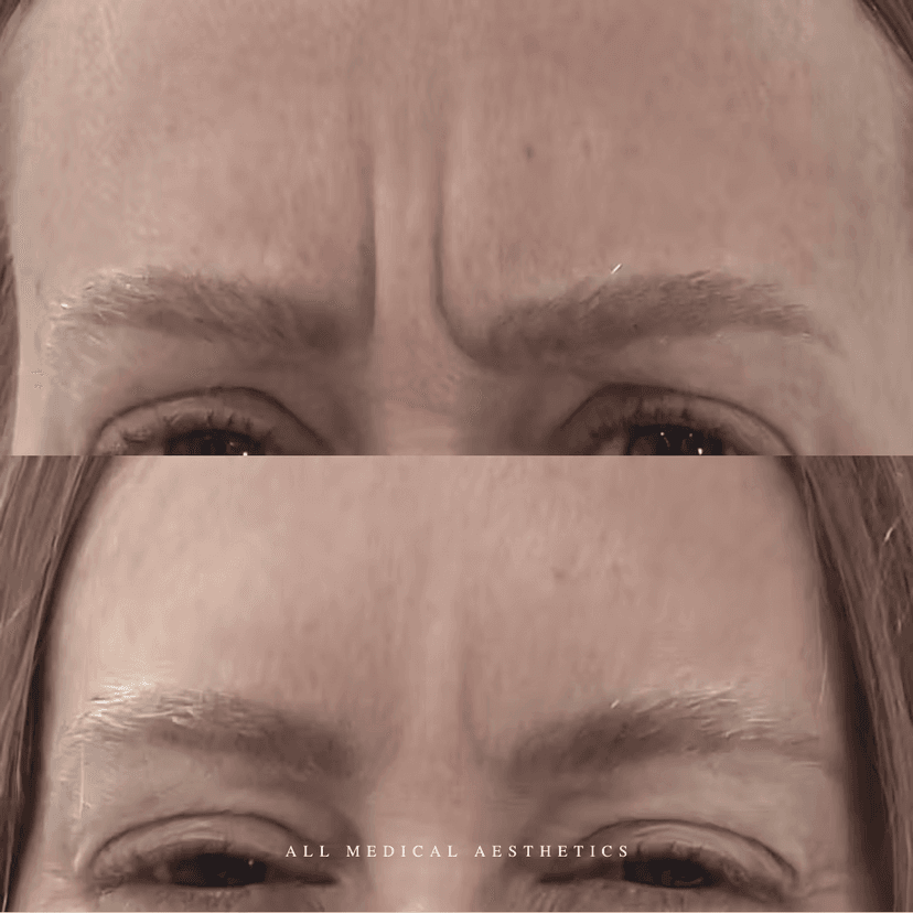 Before and after treatment for lines and wrinkles