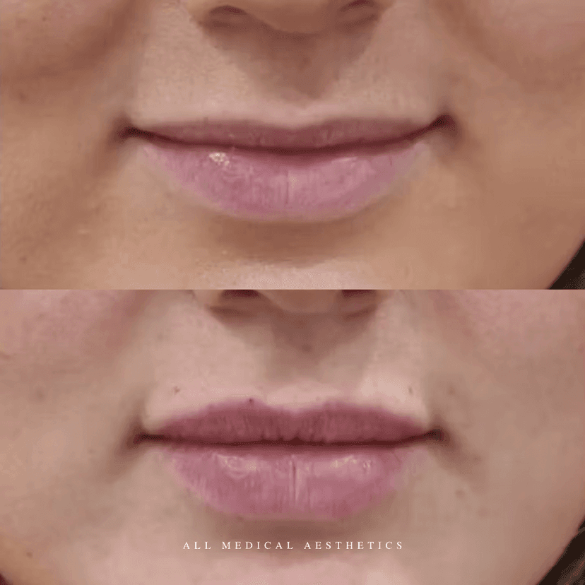 Before and after treatment for lip flip