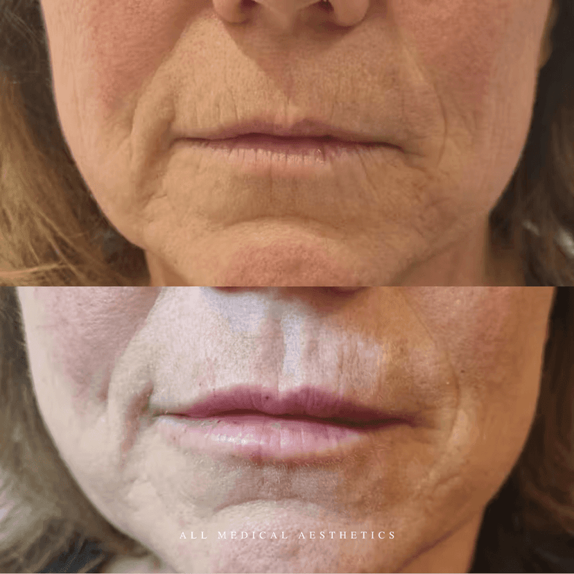 Before and after treatment for dermal fillers