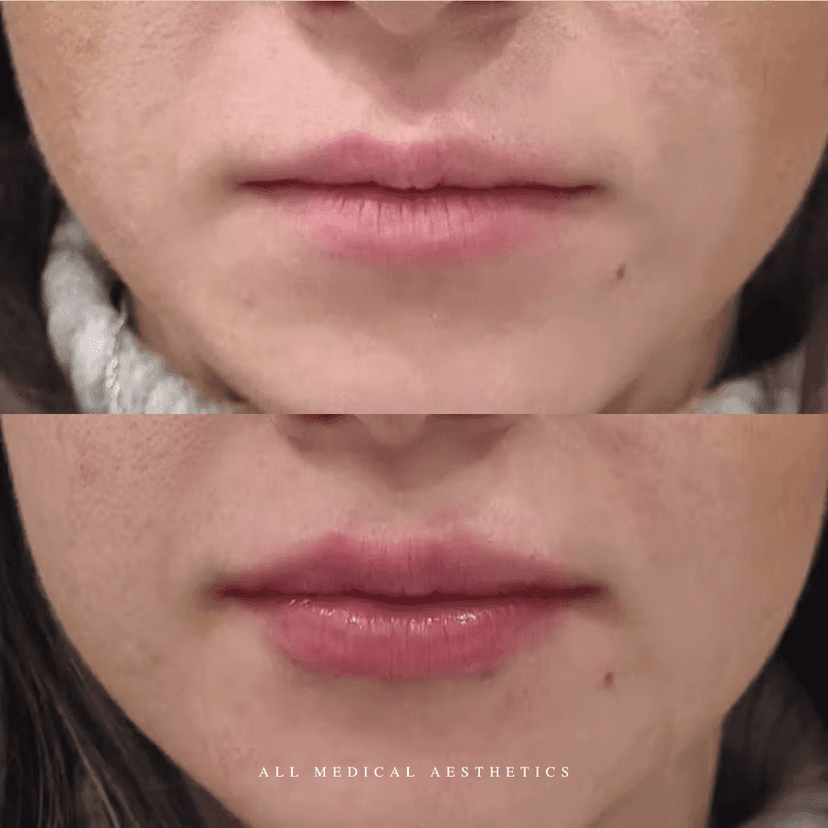 Before and after treatment for dermal fillers