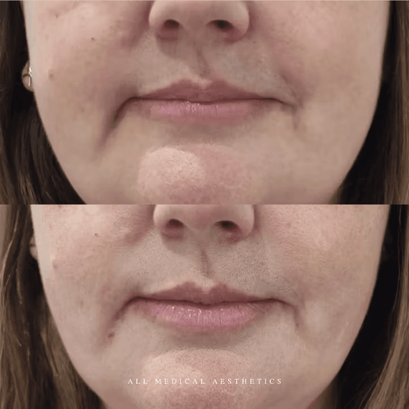 Before and after treatment for dermal fillers